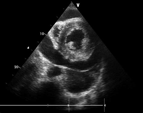 Parasternal Short Axis View Of The Heart At The Level Of The Papillary