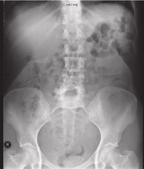Abdominal X Ray Labeled