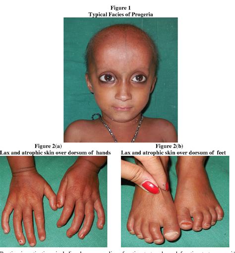 Figure 1 From Hutchinson Gilford Progeria Syndrome With Associated