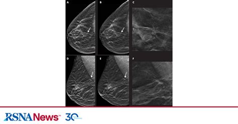 Tomosynthesis With Synthetic Mammography For Breast Cancer Detection Rsna
