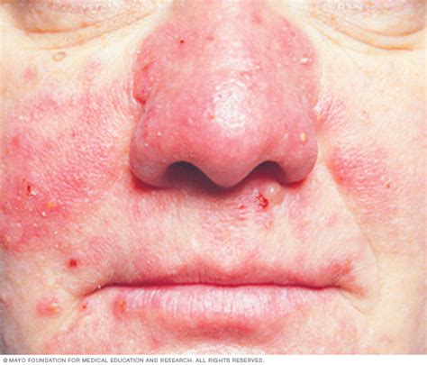 Rosacea Disease Reference Guide