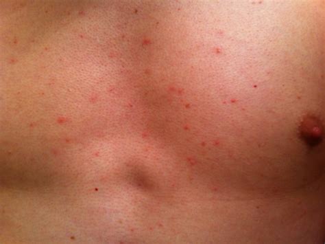 Small Red Spots On Chest Pictures Photos