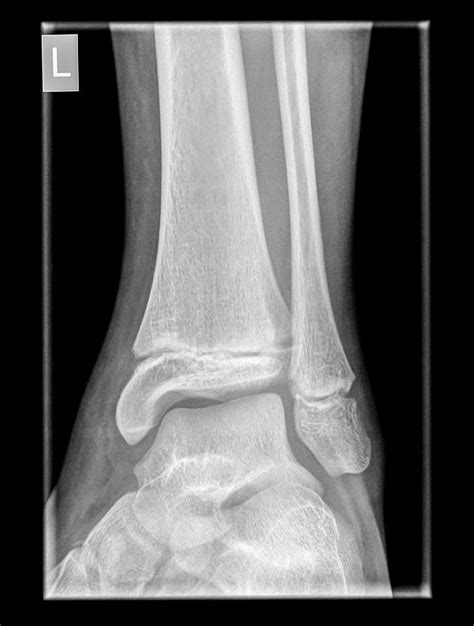 Ankle X Ray Photograph By Photostock Israel Fine Art America