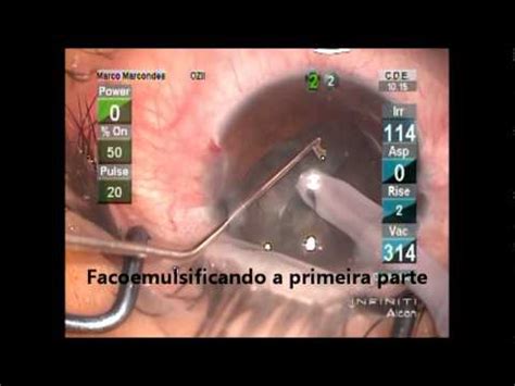 Cataract Surgery Cirurgia De Catarata Youtube