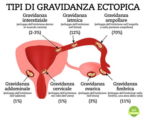 Gravidanza Ectopica Cos Come Riconoscerla E Cosa Fare The Best Porn Website