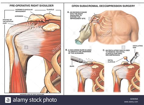 Shoulder impingement syndrome develops when the shoulder tendons get intermittently trapped and squashed underneath one of the shoulder bones, the acromion. Right Shoulder Impingement Syndrome with Decompression ...