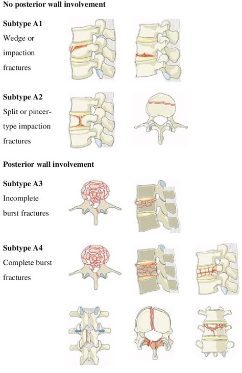 Type A Compression Injuries Of The Vertebral Body Download Scientific