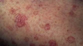Porokeratosis Causes Treatment And More