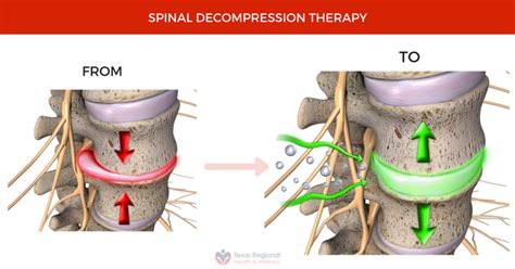 Spinal Decompression Therapy Texas Regional Health