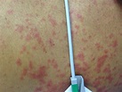 Large, Spreading Rash After Illness - Page 3 of 4 - Clinical Advisor