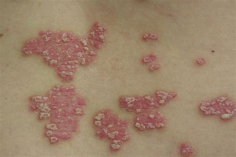Psoriasis In Children Symptoms Types And How To Deal With It