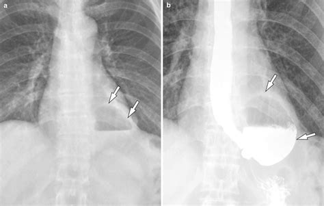 Benign Structural And Functional Abnormality Of The Esophagus