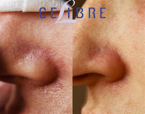 Spider Vein Removal Before And After Pictures