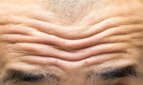 How To Get Rid Of Lines On Forehead Treatment Not Botox