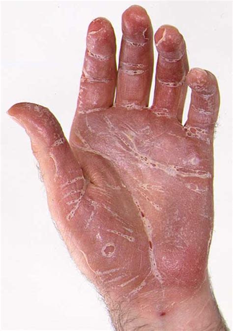 Psoriasis On Elbows Hands Legs Beck Neck And Other Parts Of Body