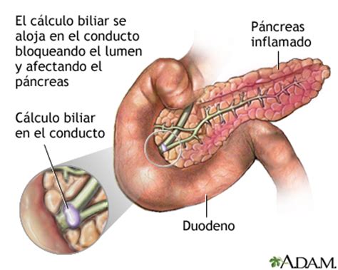 Pancreatitis Serieindicaciones Medlineplus Enciclopedia M Dica