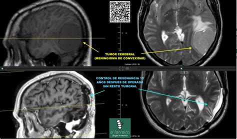 Tumor Cerebral Dr Edgar Ferreira Neurocirujano