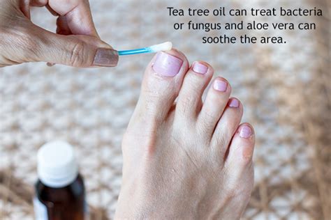 Foot Rashes Causes Treatment And Home Remedies