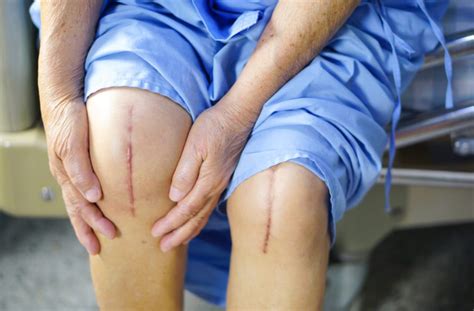 What Causes Blisters After Knee Replacement Surgery Hot Sex Picture