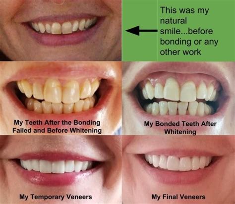 porcelain veneers before and after porcelain veneers veneers veneers teeth