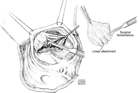 Cone Reconstruction Of The Tricuspid Valve For Ebsteins Anomaly