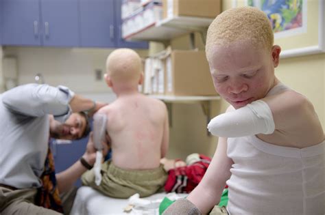 New Limbs And New Hope For Africas Hunted Albino Children Orlando