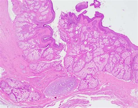 Dermoid Cyst Mature Cystic Teratoma Ovary Bosnianpathology