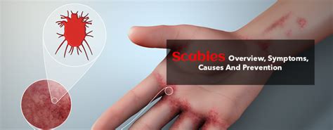 scabies overview symptoms causes and prevention