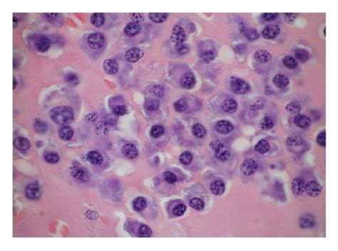 Plasma Cells Presented Eccentric Nuclei And Atypical Cytology