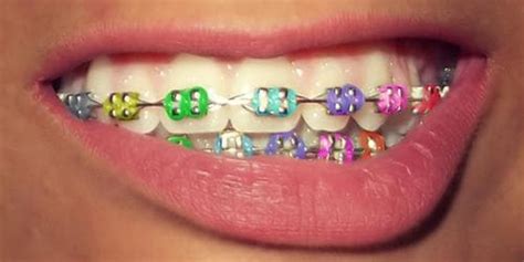 Brackets De Colores Tu Sonrisa De Colores Dental Tacna
