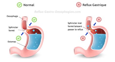 Quoi Faire Reflux Gastrique Reflux Gastrique Traitement Crpodt