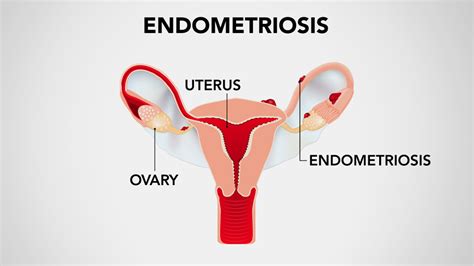 Fibroids Endometriosis Pcos And Dyspareunia A Primer On These Common