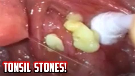 Tonsil Stone Removal 2018 Youtube