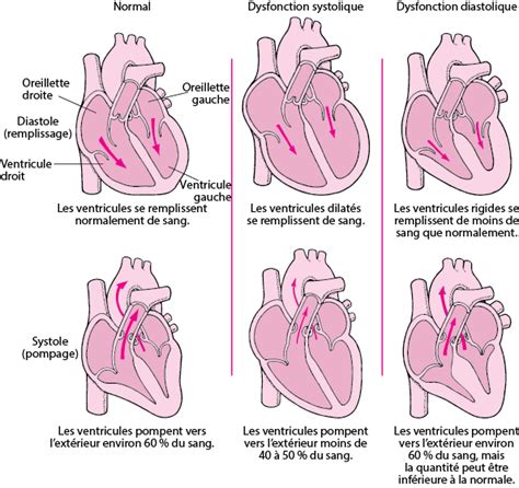 Insuffisance Cardiaque Ic Troubles Cardiaques Et Vasculaires