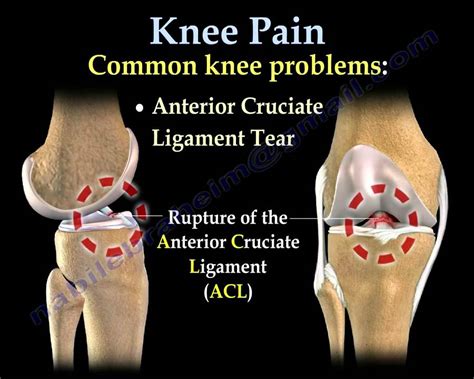 Knee Pain Causes And Tips To Manage Knee Pain By Dr M Vrogue Co