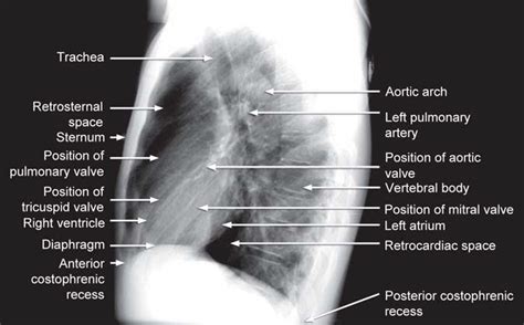 Labeled Lateral Chest X Ray