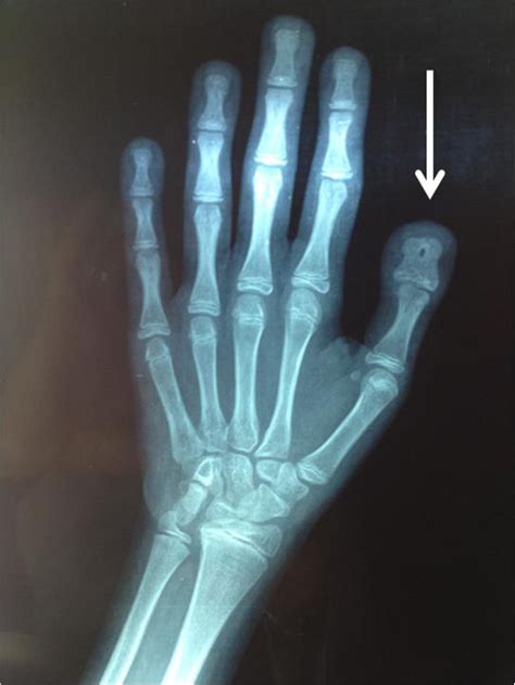 This Hand Wrist Radiograph Was Made When She Was 14 Years Old The