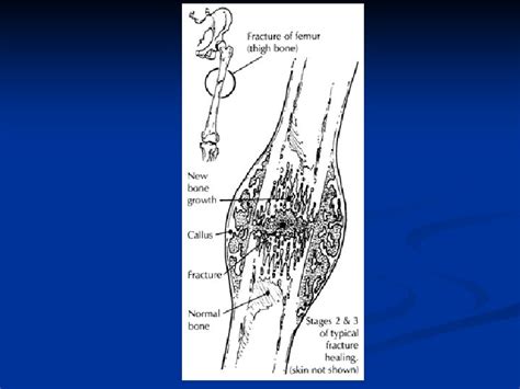 Musculoskeletal Block Pathology Lecture 1 Fracture And Bone