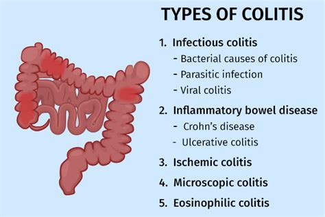 Colitis Types Symptoms Treatment Risk Factors