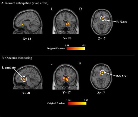 Enhanced Neural Responses In Specific Phases Of Reward Processing In Individuals With Internet