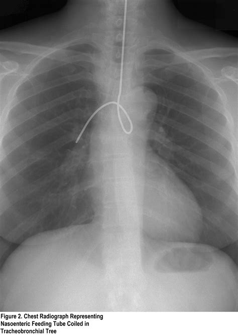 Checking Nasogastric NG Tube Position Oxford Medical Education