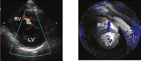 Muscular Vsd Short Axis Views From Echocardiography And Real Time