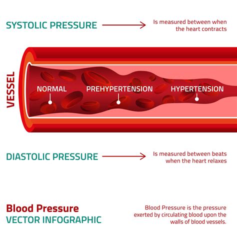 High Blood Pressure Hypertension Medinformer