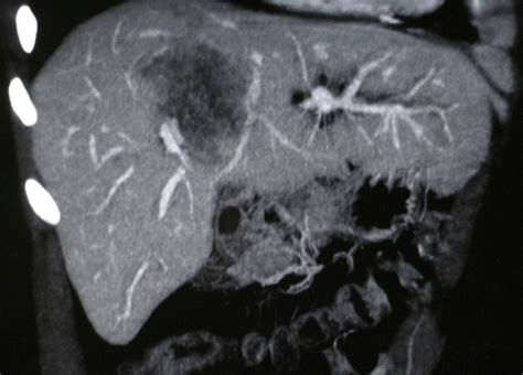 Ct Scan Showing In Segment 8 And 4 A Large Liver Mass Measuring 60 × 85
