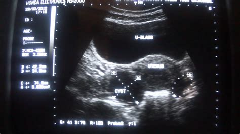 Female Abnormal Pelvic Ultrasound 16 Best Female Pelvic Ultrasound Images On Pinterest