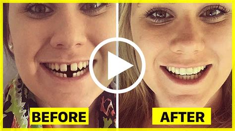 Before And After Braces 114 Incredible Transformations Of People Who