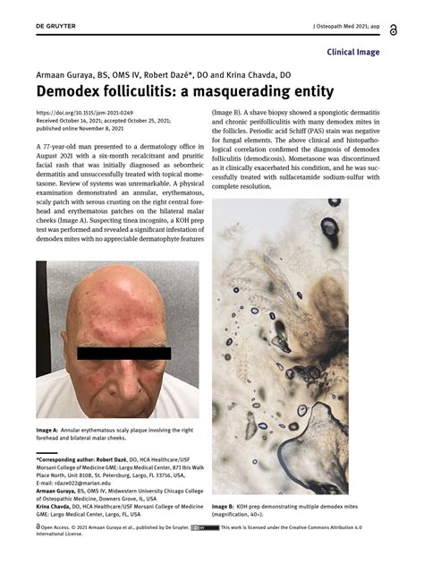 Pdf Demodex Folliculitis A Masquerading Entity