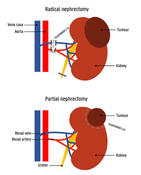 Laparoscopic Radical Nephrectomy For Renal Cancer Urologist