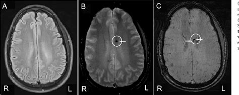 Figure 2 From Diffuse Axonal Injury After Traumatic Cerebral