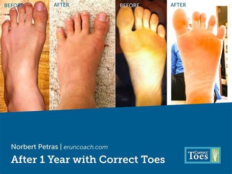 Correct Toes Sizing How To Wear Correct Toes Natural Foot Health